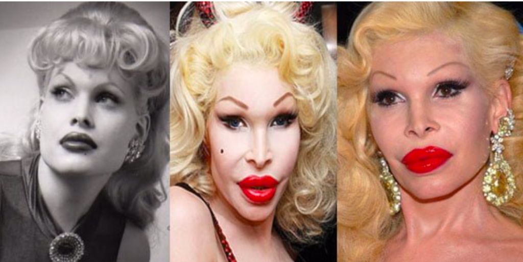 Times Plastic Surgery Went Horribly Wrong For Celebrities